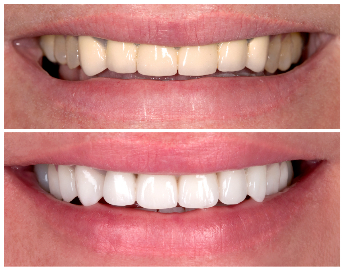 ホワイトニング前の歯とホワイトニング後の比較