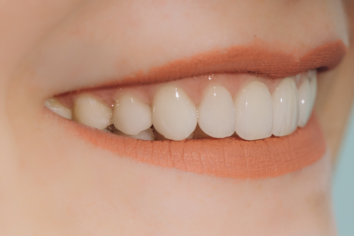 歯のセラミック治療とは？種類と費用、銀歯との違いを解説！