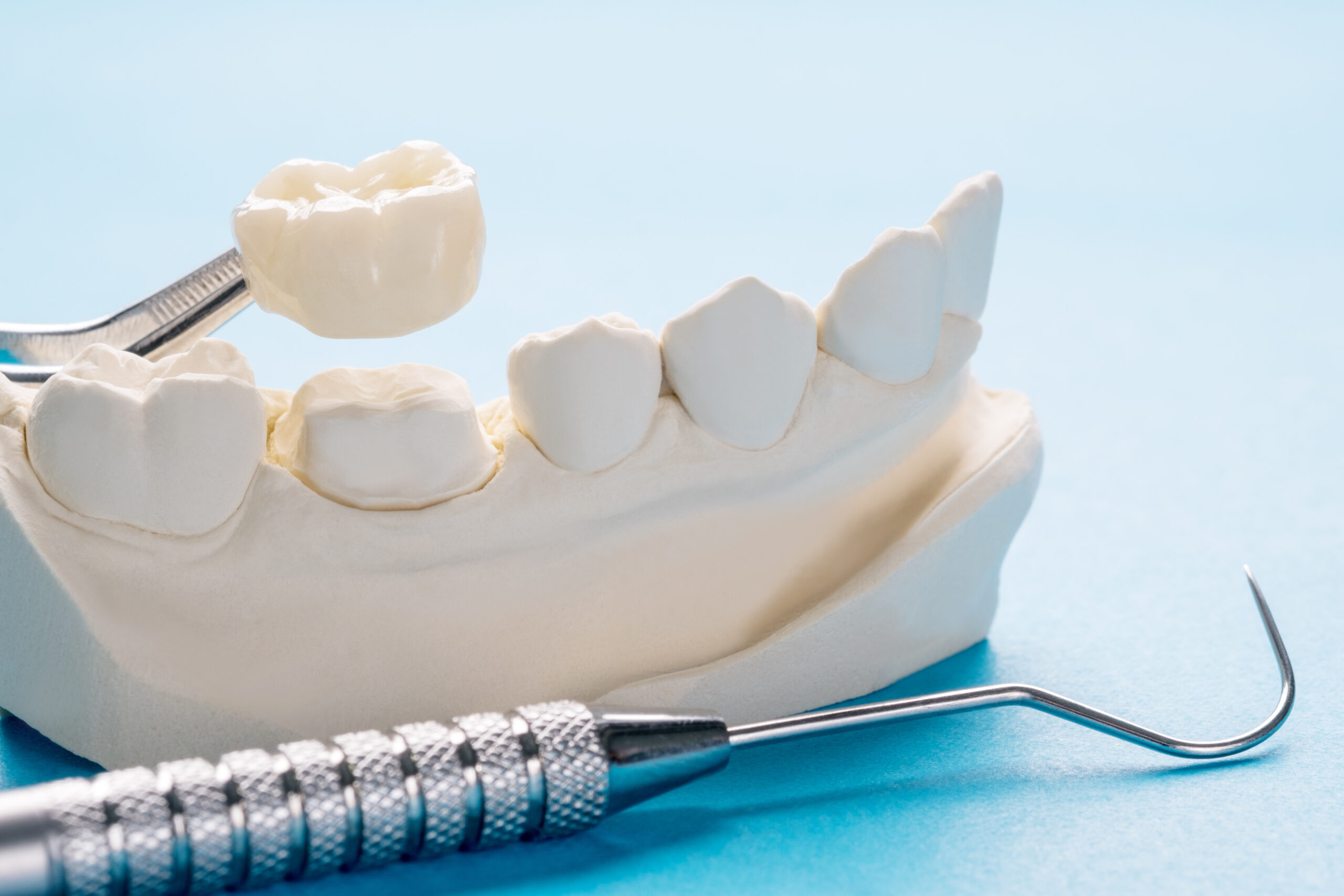 歯のセラミック治療は保険が適用される？費用を安くする方法も解説