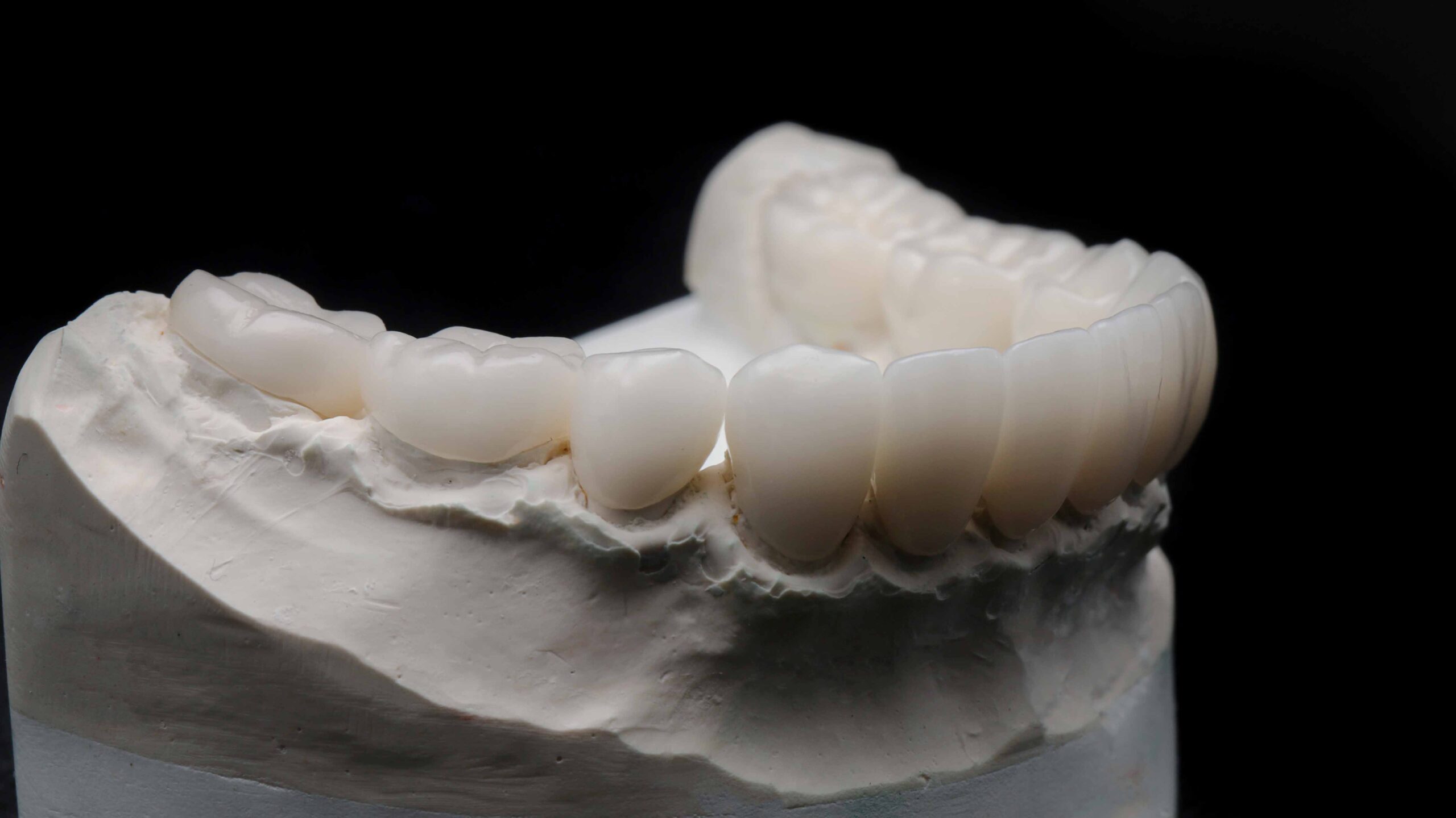セラミック歯は何年もつ？寿命に影響を与える要因と長持ちの秘訣