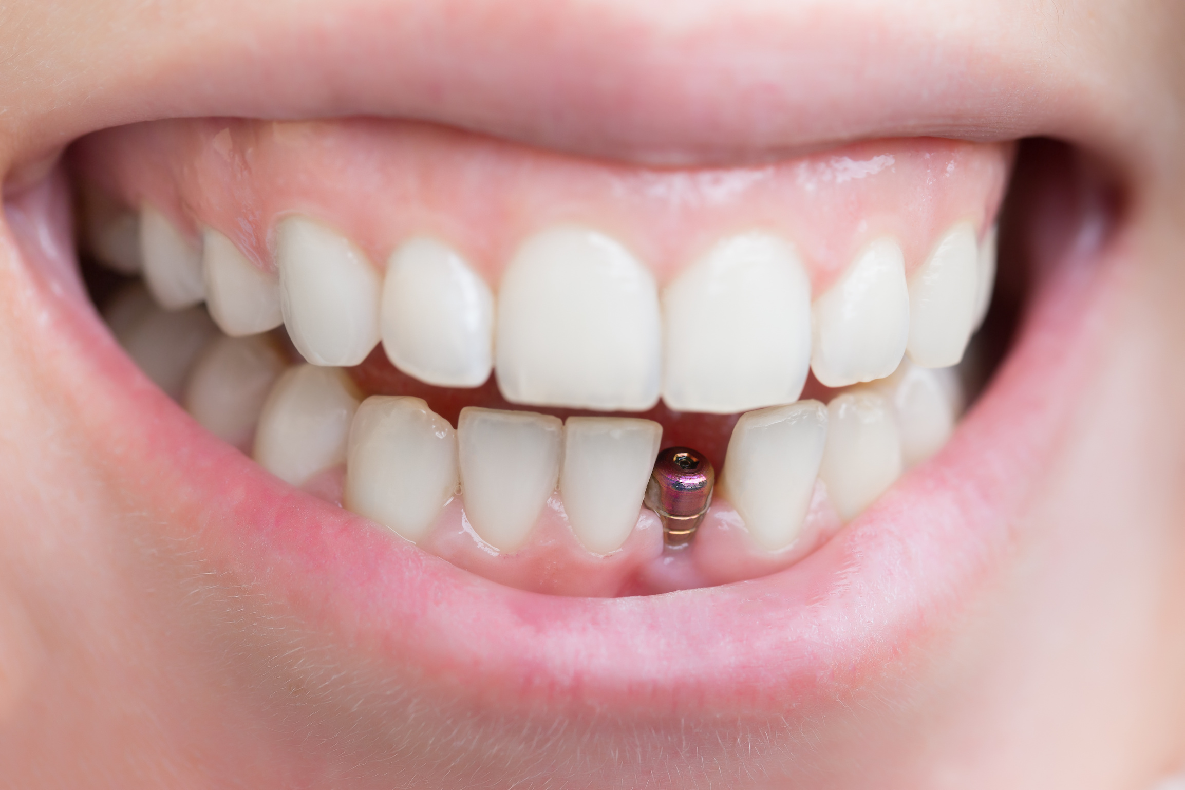 インプラント治療中に歯がない期間はどうする？対処法と注意点を解説