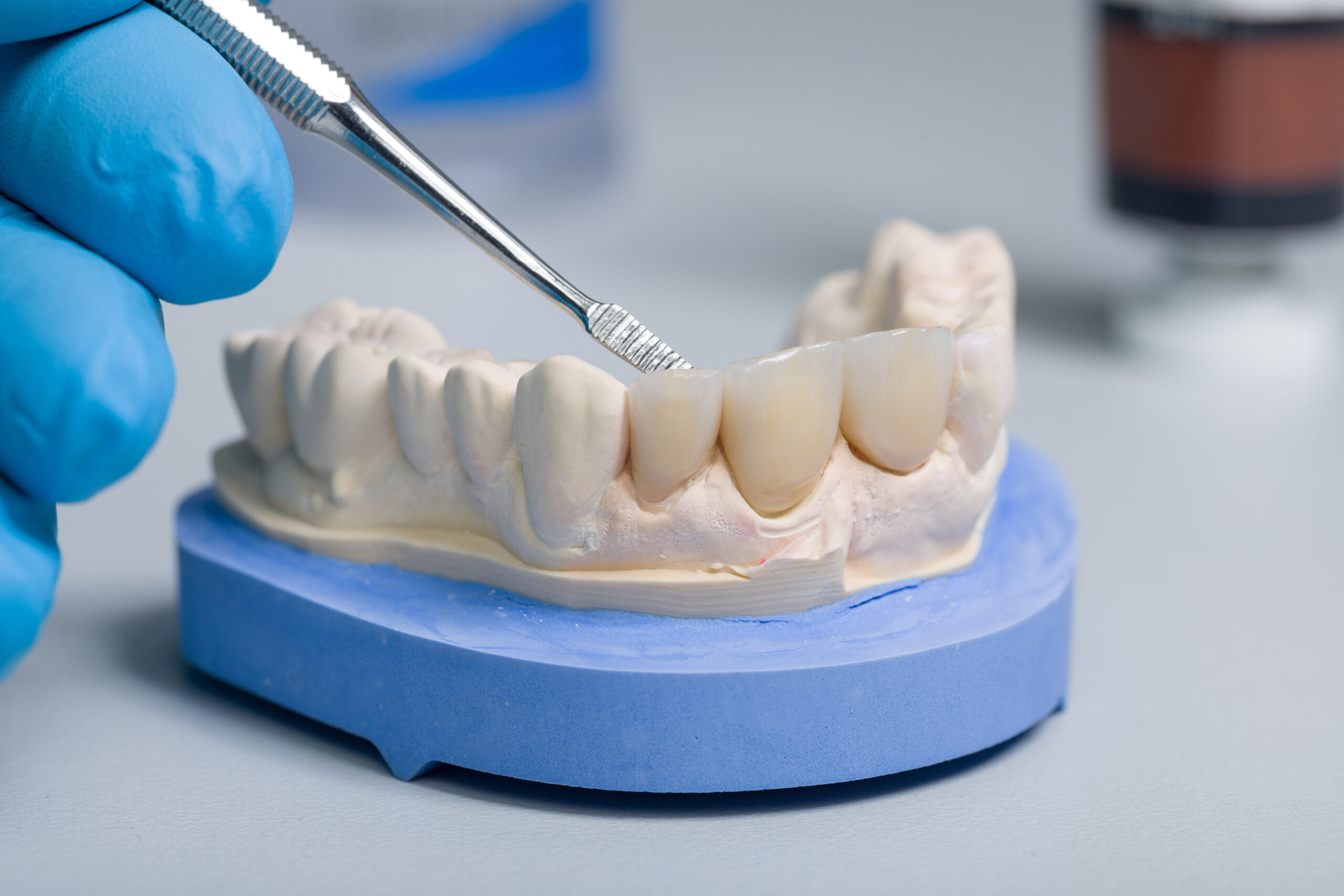 前歯のセラミック治療イメージ