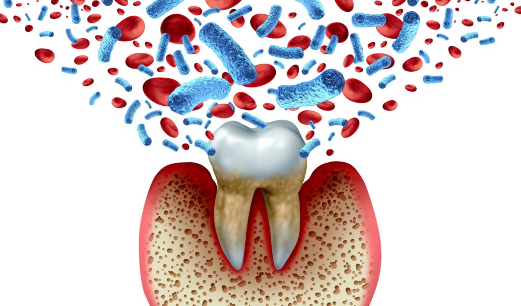 細菌により歯周病になるイメージ