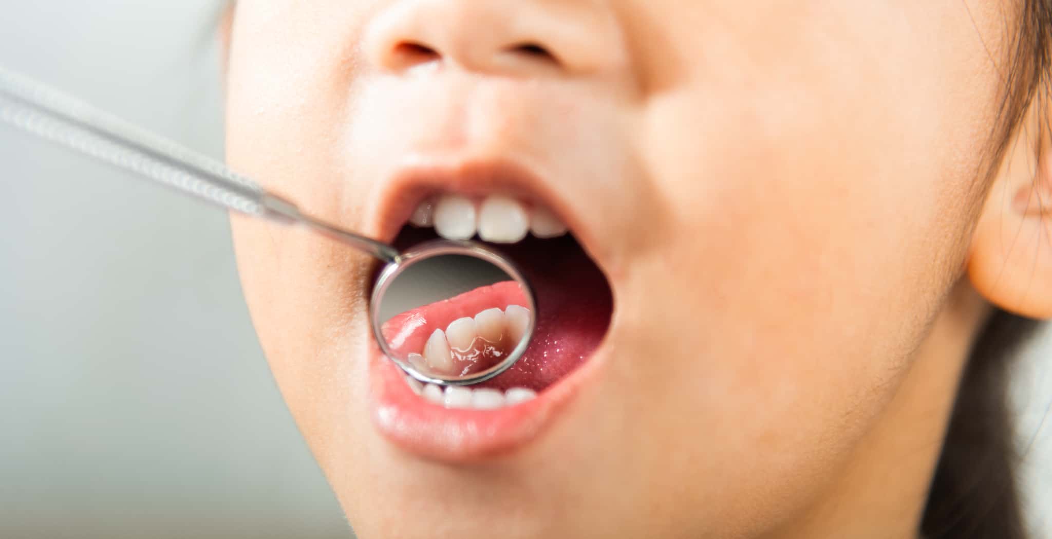 子どもの虫歯予防で定期歯科検診を受けるイメージ