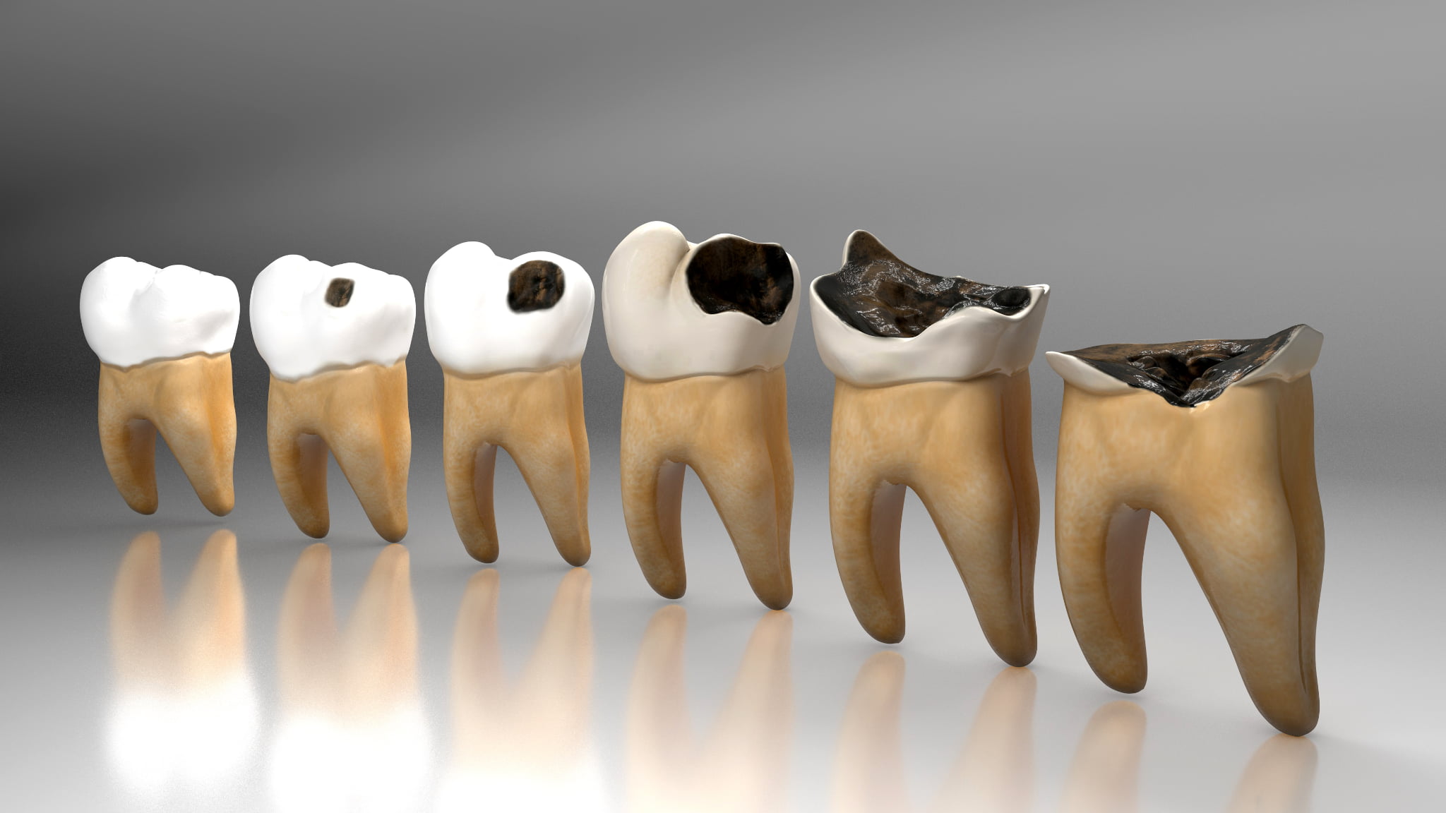 虫歯の進行のイメージ